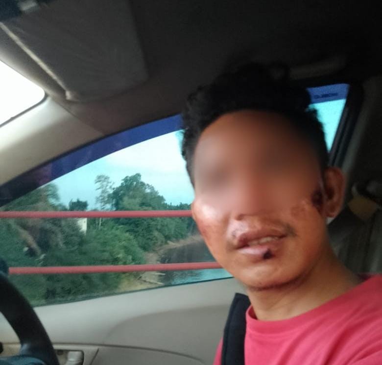 Korban Salah Tangkap Beberkan Foto Usai Dianiaya Oknum Polisi